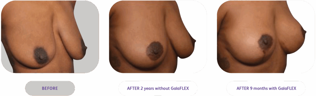 breast lift