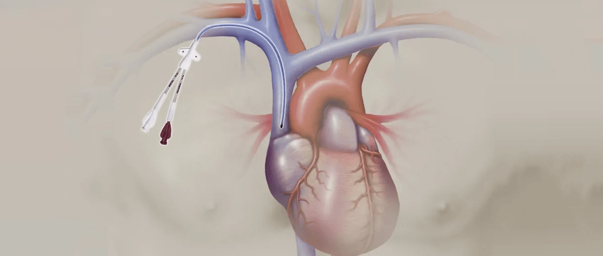 Drawing of the heart and coronary arteries showing a central venous catheter inserted into the aorta