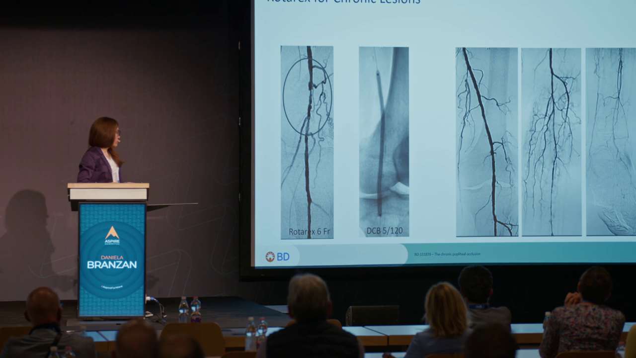 The challenge in popliteal arteries and below