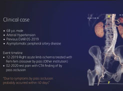 Rotarex™S Iliac limb thrombosis