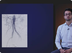 Rotarex™S case examples