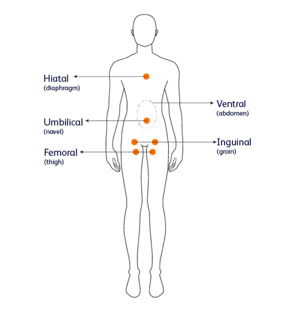 Hernia types